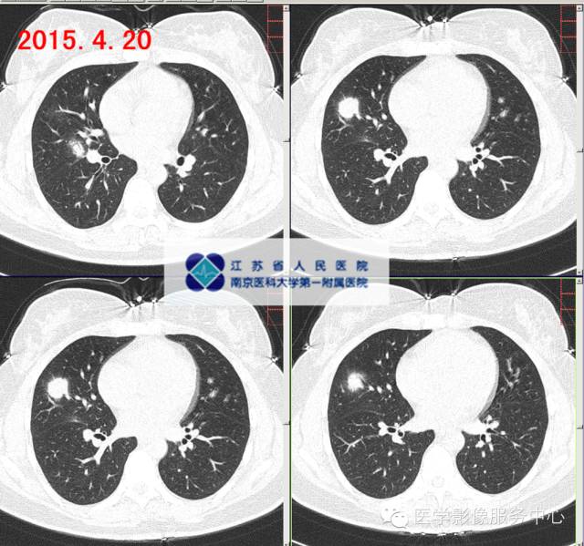 【病例】肺隐球菌病1例CT影像表现 【病例】肺隐球菌病1例CT影像表现