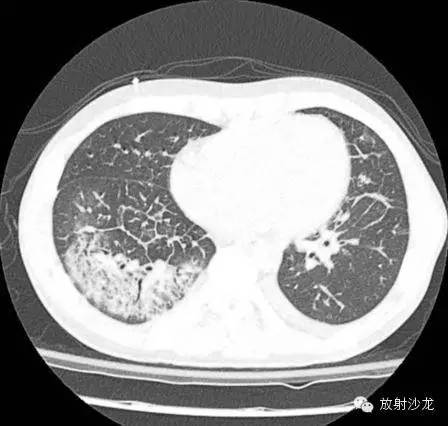 【病例】急性纤维素性机化性肺炎1例CT影像表现