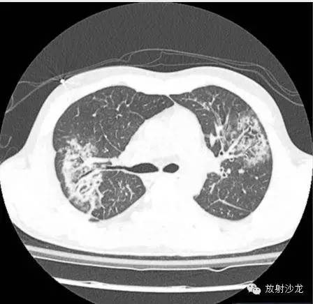 【病例】急性纤维素性机化性肺炎1例CT影像表现