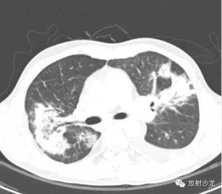 【病例】急性纤维素性机化性肺炎1例CT影像表现