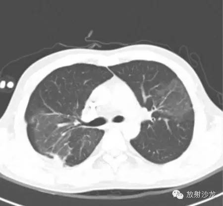 【病例】急性纤维素性机化性肺炎1例CT影像表现
