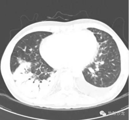 【病例】急性纤维素性机化性肺炎1例CT影像表现