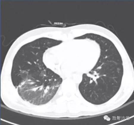 【病例】急性纤维素性机化性肺炎1例CT影像表现