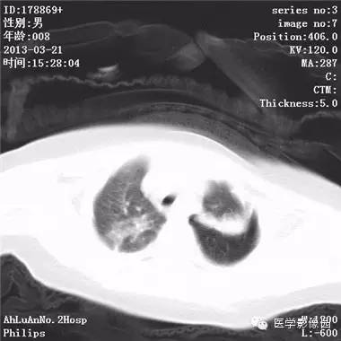 【病例】支气管异物1例CT影像表现