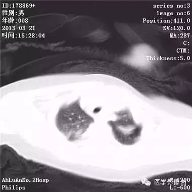 【病例】支气管异物1例CT影像表现