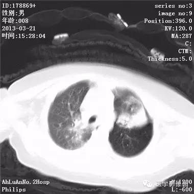 【病例】支气管异物1例CT影像表现