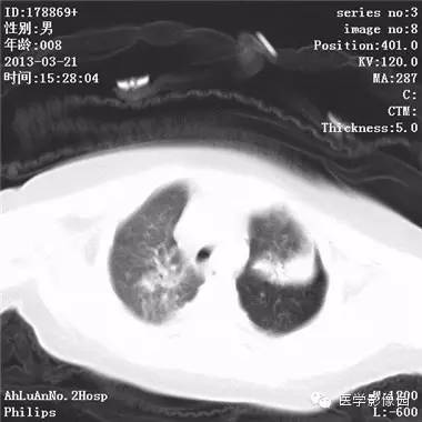 【病例】支气管异物1例CT影像表现