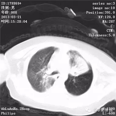 【病例】支气管异物1例CT影像表现
