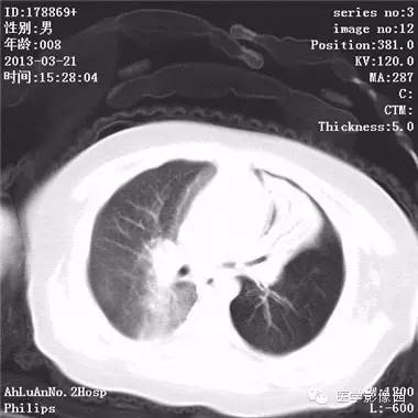 【病例】支气管异物1例CT影像表现