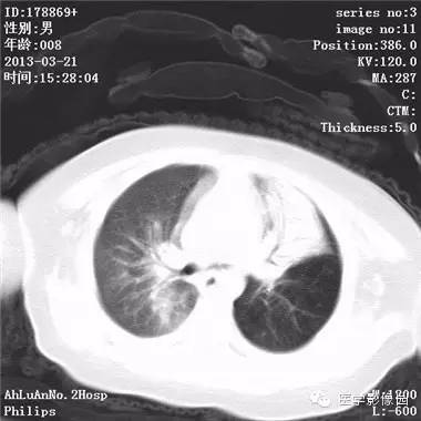 【病例】支气管异物1例CT影像表现
