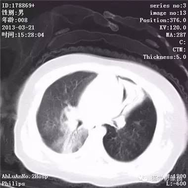 【病例】支气管异物1例CT影像表现