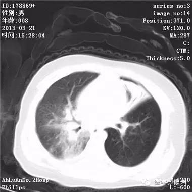 【病例】支气管异物1例CT影像表现