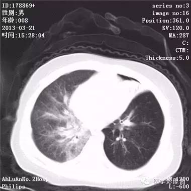 【病例】支气管异物1例CT影像表现
