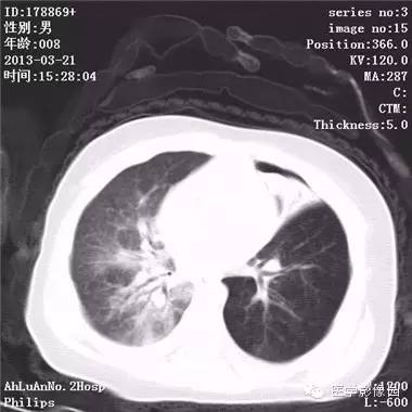 【病例】支气管异物1例CT影像表现