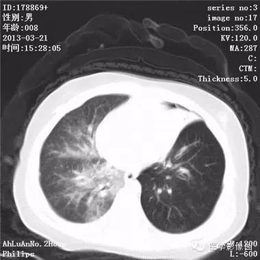 【病例】支气管异物1例CT影像表现