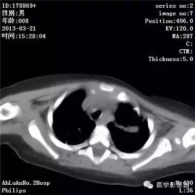 【病例】支气管异物1例CT影像表现