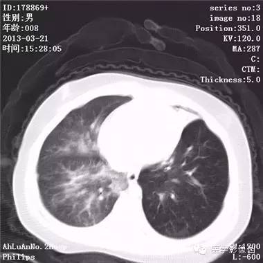 【病例】支气管异物1例CT影像表现