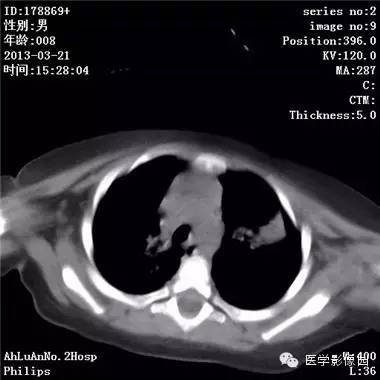 【病例】支气管异物1例CT影像表现