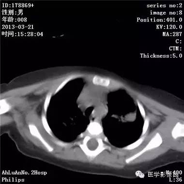 【病例】支气管异物1例CT影像表现