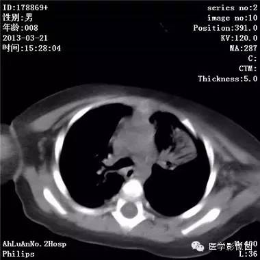 【病例】支气管异物1例CT影像表现