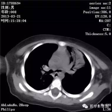 【病例】支气管异物1例CT影像表现
