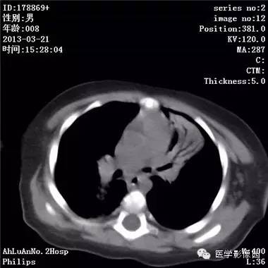 【病例】支气管异物1例CT影像表现