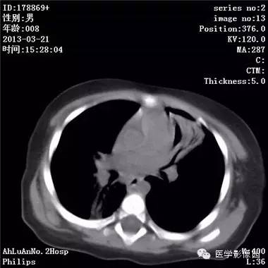 【病例】支气管异物1例CT影像表现