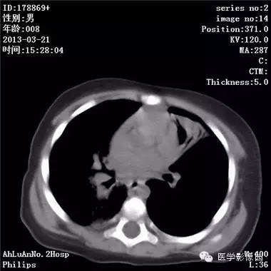 【病例】支气管异物1例CT影像表现