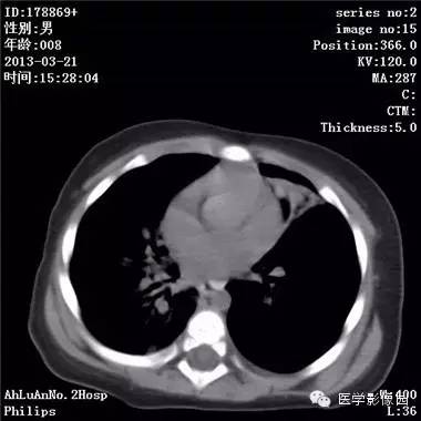 【病例】支气管异物1例CT影像表现