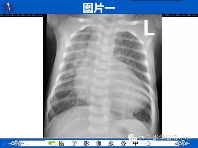【影像征象】鸡蛋挂线征——大动脉转位征