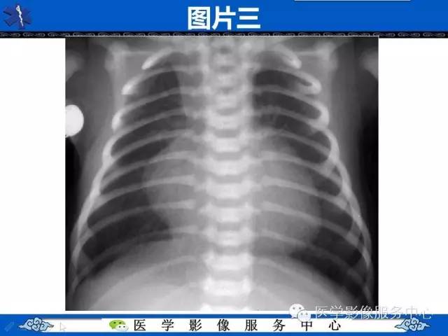 【影像征象】鸡蛋挂线征——大动脉转位征