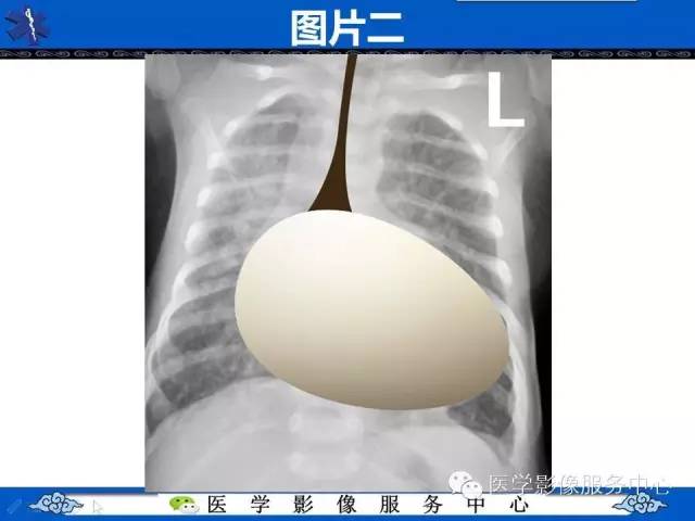 【影像征象】鸡蛋挂线征——大动脉转位征