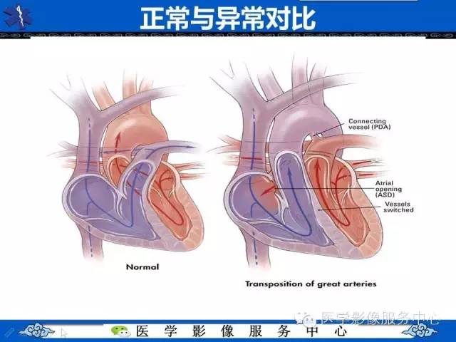 【影像征象】鸡蛋挂线征——大动脉转位征