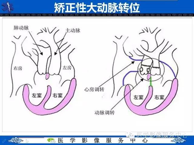 【影像征象】鸡蛋挂线征——大动脉转位征