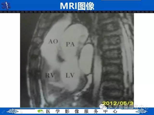 【影像征象】鸡蛋挂线征——大动脉转位征