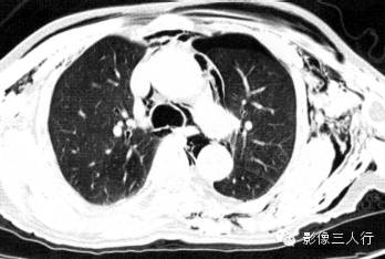 纵隔气肿的CT报告书写技巧与提示 纵隔气肿的CT报告书写技巧与提示