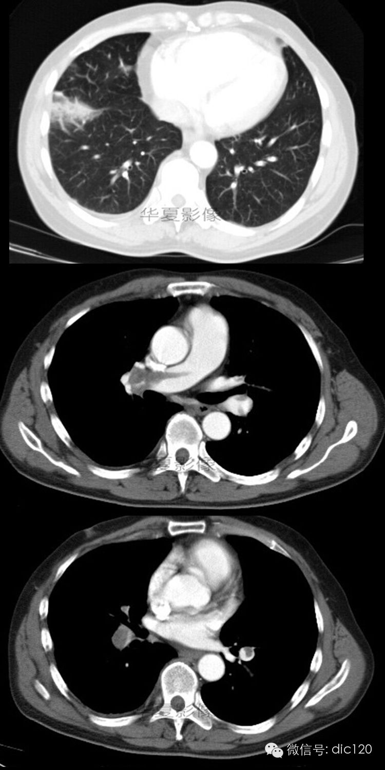 【病例】肺动脉栓塞并肺梗死1例CT影像表现