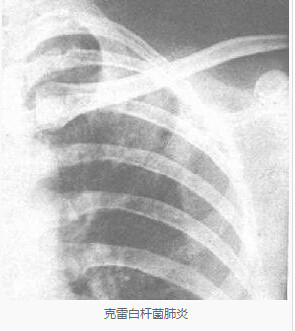 八种常见肺炎的X线诊断 八种常见肺炎的X线诊断