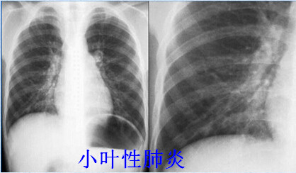 八种常见肺炎的X线诊断 八种常见肺炎的X线诊断