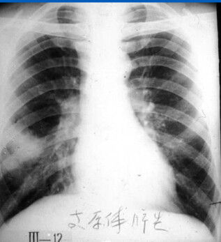 八种常见肺炎的X线诊断 八种常见肺炎的X线诊断