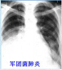 八种常见肺炎的X线诊断 八种常见肺炎的X线诊断