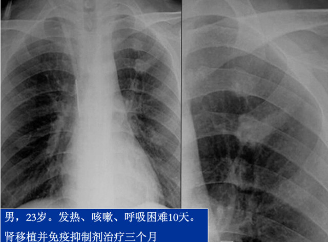 八种常见肺炎的X线诊断 八种常见肺炎的X线诊断