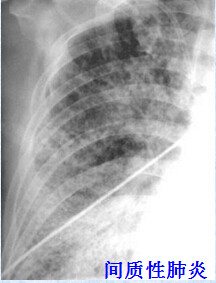 八种常见肺炎的X线诊断 八种常见肺炎的X线诊断