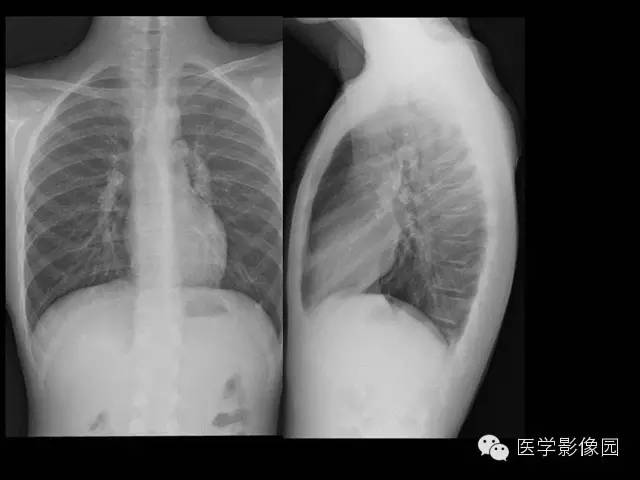 【病例】组织胞浆菌病1例CT影像表现