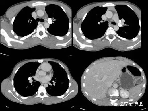 【病例】组织胞浆菌病1例CT影像表现