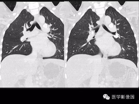 【病例】组织胞浆菌病1例CT影像表现