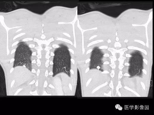 【病例】组织胞浆菌病1例CT影像表现
