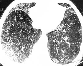 肺转移瘤的CT报告书写技巧与提示