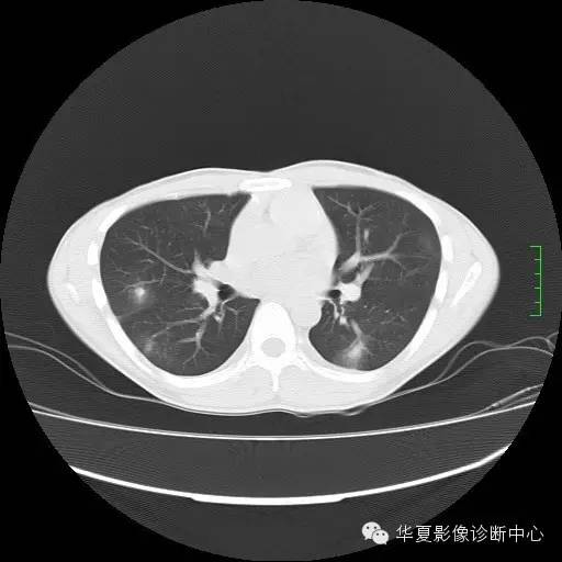 【病例】嗜酸细胞肺炎1例CT影像表现