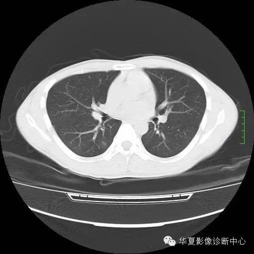 【病例】嗜酸细胞肺炎1例CT影像表现